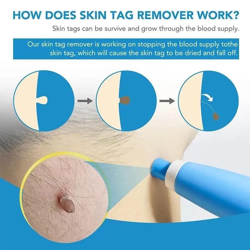 Skin tag removal for neck underarms face body safe natural treatment areas effective