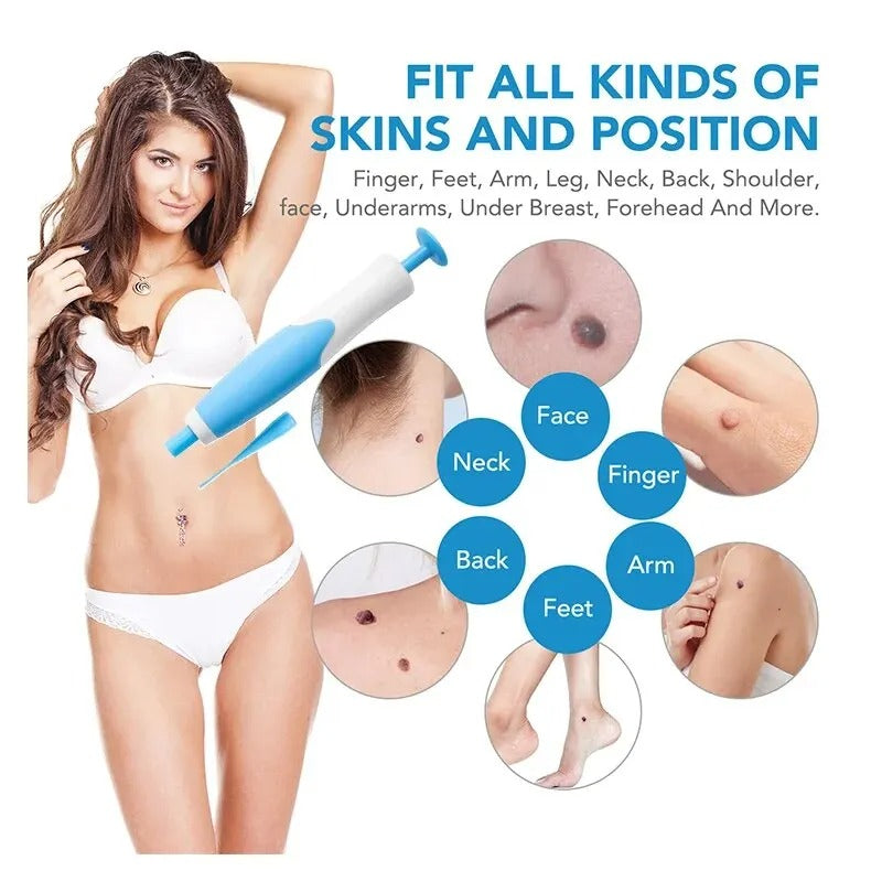 Easy 3 step skin tag removal process at home painless natural treatment gentle formula