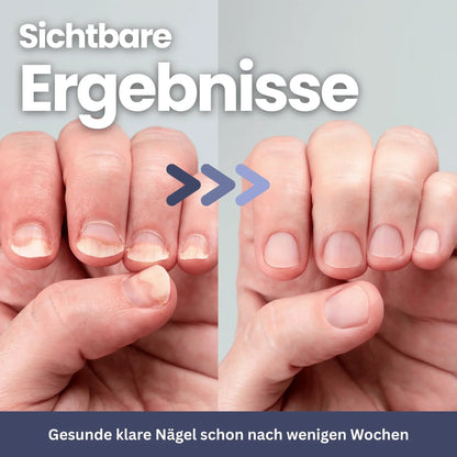 NailCare – Nagelpilztherapie mit UV-Licht