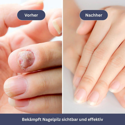 NailDrops - Pflegeserum gegen Nagelpilz