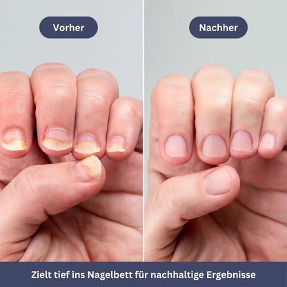 NailPen – Reparaturstift gegen Nagelpilz & Entzündungen