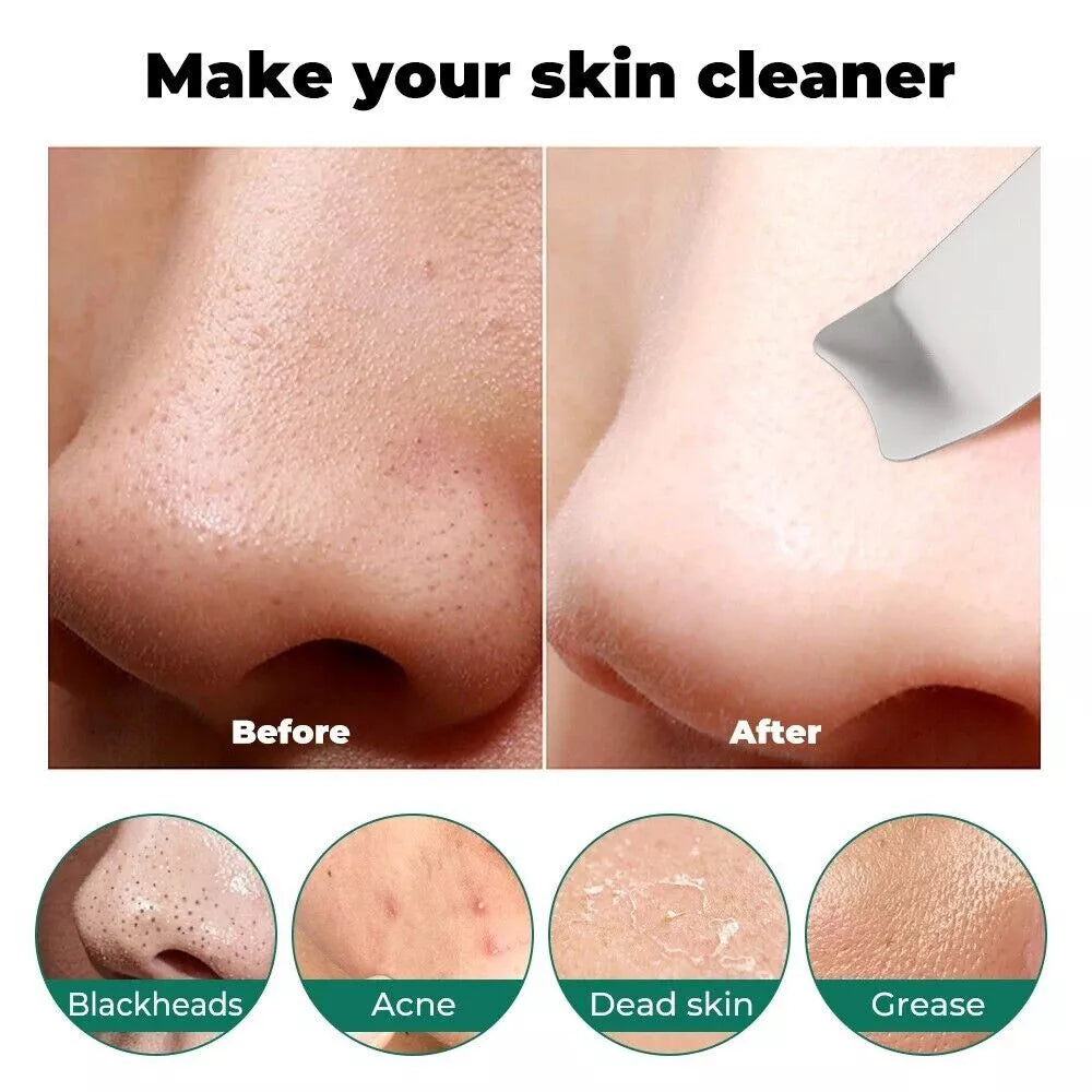 Ultrasonic Skin Scrubber Blackhead Remover – Deep Facial Cleansing & Exfoliation