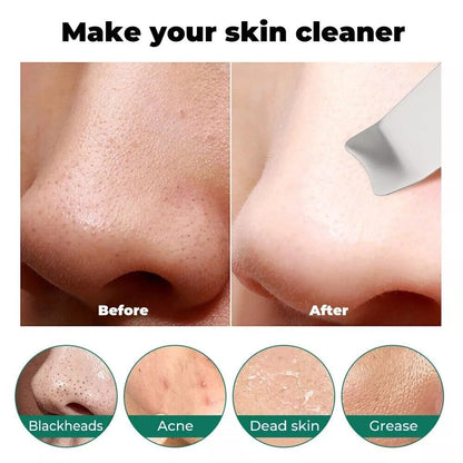 Ultrasonic Skin Scrubber Blackhead Remover – Deep Facial Cleansing & Exfoliation